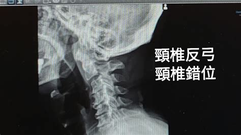 反弓|頸椎反弓：症狀、病因及如何治療